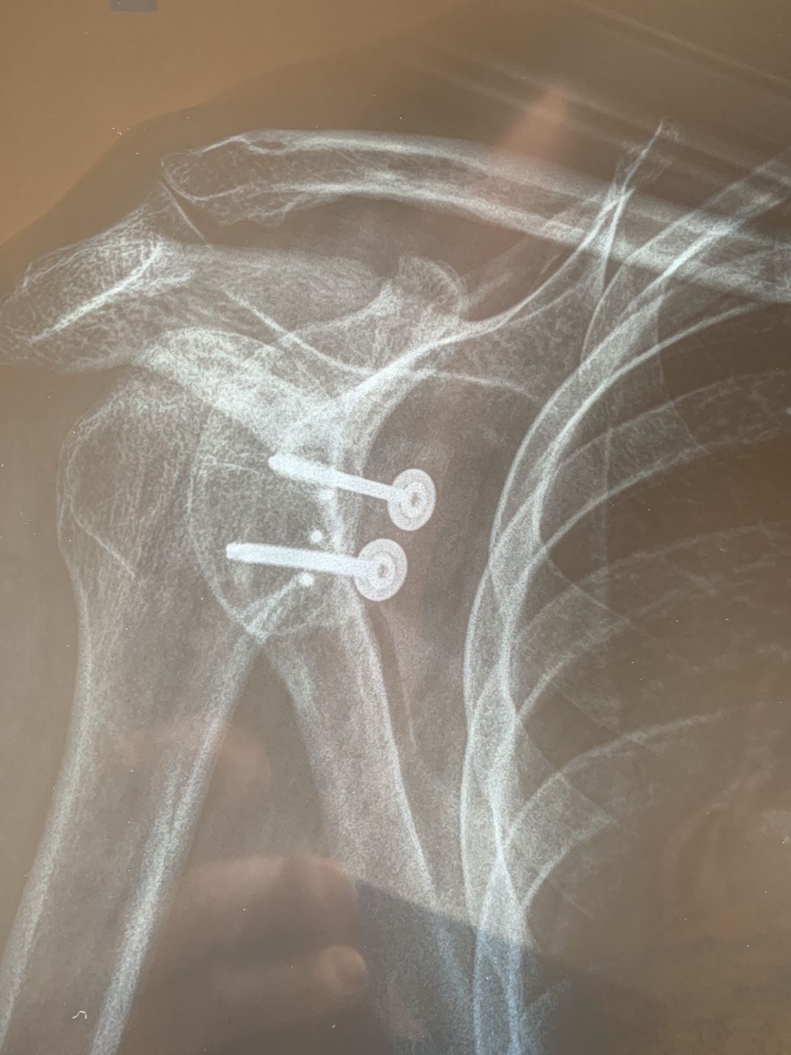 X-ray of Phillipe Cossey's shoulder showing surgical anchors after reconstruction.